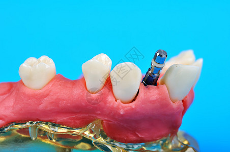 植入蓝色颌骨分离物中的牙科钛植入物图片