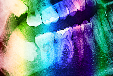 人类头骨与牙齿的牙科X射线照片图片