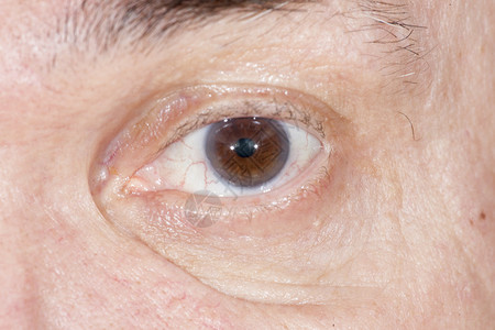 眼科检查中的老年白内障特写图片