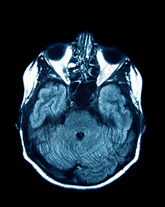 脑部核磁图片