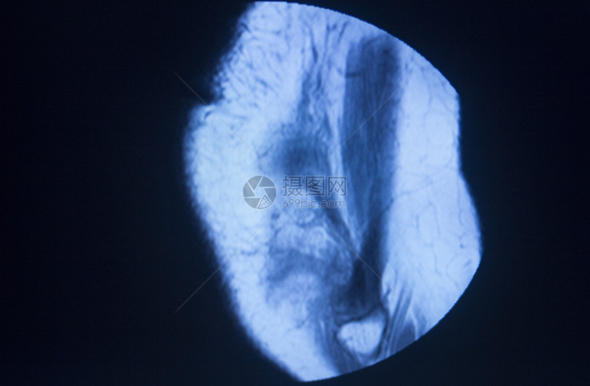 MRI磁共振成像医学扫描测试结果显示膝关节半月板股骨和小腿韧带软骨和人体骨骼图片