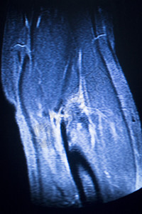 磁共振成像医学扫描测试肘部检查结果显示图片