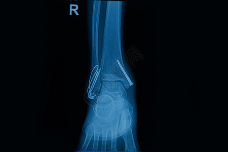 收集显示右腿骨折两根骨头折图片