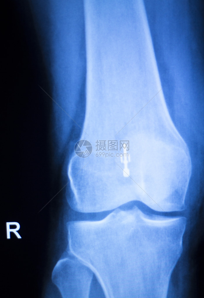 膝关节半月板X射线测试扫描结果照片显示损伤和疼痛以及整形外科和创伤外科图片