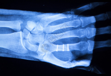 手指和大拇指医院X射线扫描检查结果图片
