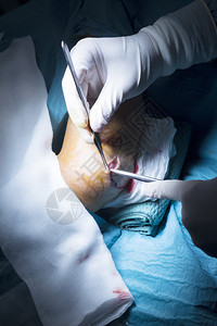 医院肘部和手臂矫形外科手术创伤治疗手图片