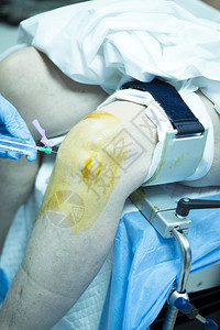 在医院急诊室手术室对腿部照片进行绝育手术时图片