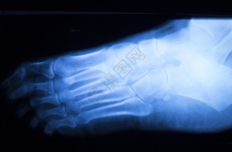 脚跟和脚趾受伤X射线扫描整形和创伤放射背景图片