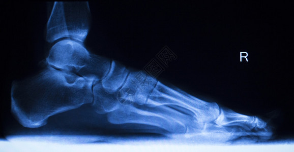 脚跟和脚趾受伤X射线扫描整形镜和创伤放射负载图片