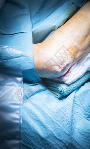 医院肘部和手臂矫形手术外科图片