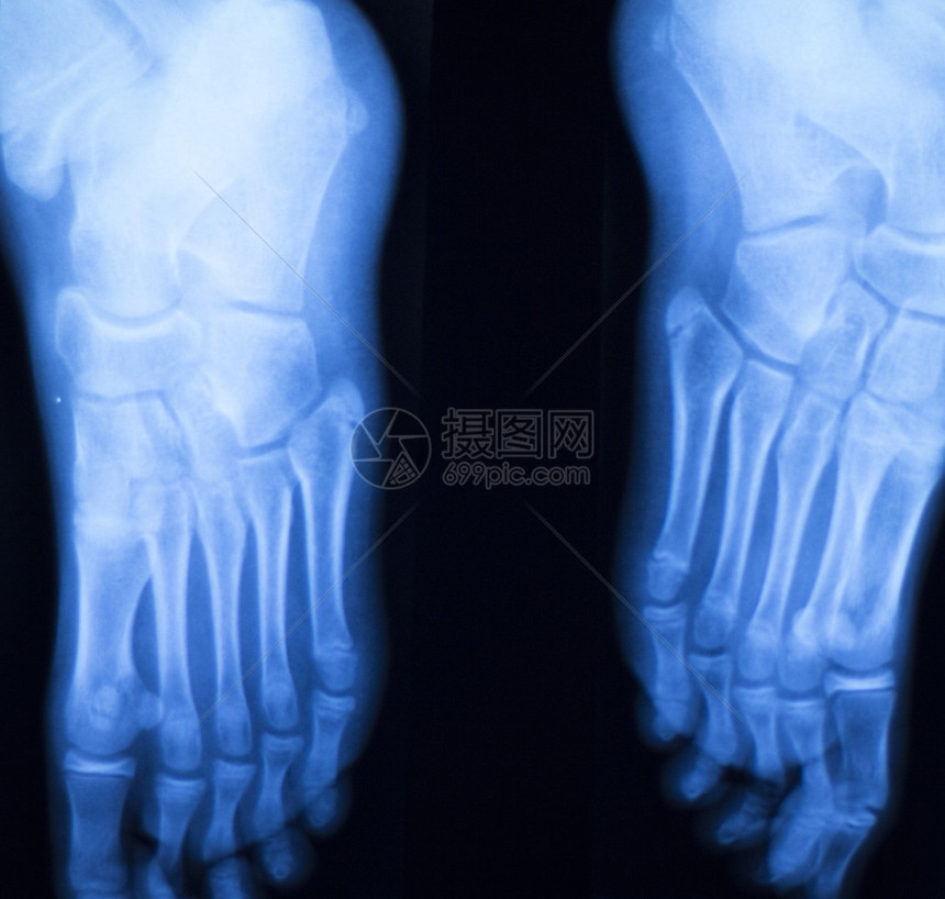 脚跟和脚趾受伤X射线扫描整形和创伤放射图片