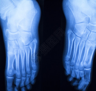 脚跟和脚趾受伤X射线扫描整形和创伤放射图片