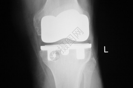 Knee和meniscus受伤医学X射线检查扫描结果显示整形创伤图片