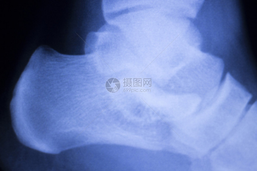 脚跟和脚踝受伤创伤医疗X射线整形图片