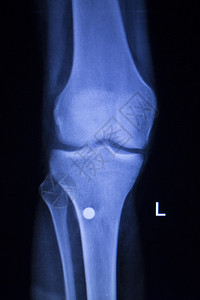 Knee和meniscus受伤医学X射线检查扫描结果显示整形创伤钛背景图片