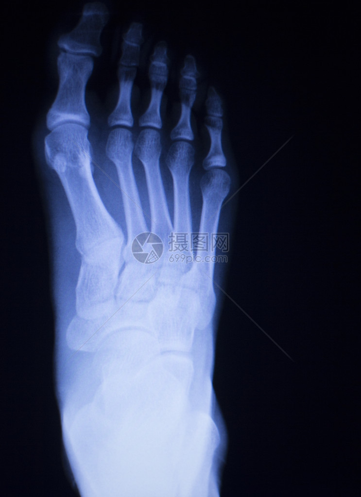 脚部和脚趾受伤创伤医疗X射线整形图片