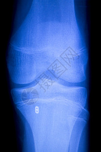 Knee和meniscus受伤医学X射线检查扫描结果显示整形创伤钛图片