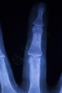手和指受伤整形创伤医学X射线图片