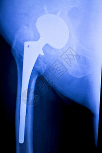 替换X射线整形医学X射线创伤测试图片