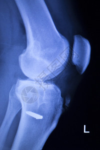 Knee和meniscus受伤医学X射线检查扫描结果显示整形创伤钛图片
