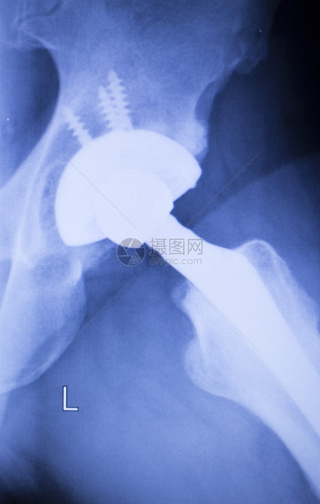 替换X射线整形医学X射线创伤测试图片