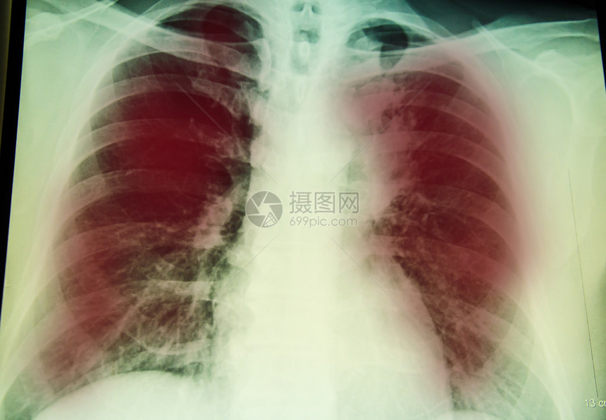 肺部和肺部结核病感染进行X射线图片