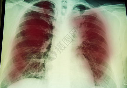 肺部和肺部结核病感染进行X射线背景图片