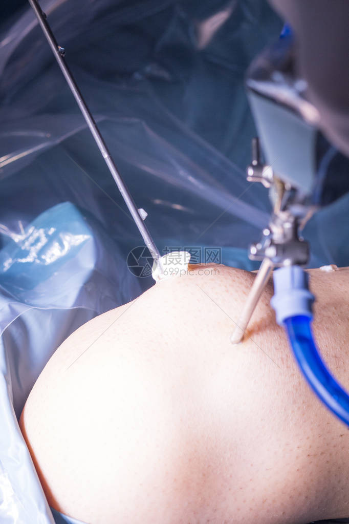 在医院手术的外科手术中进行膝盖动脉镜显微手术图片