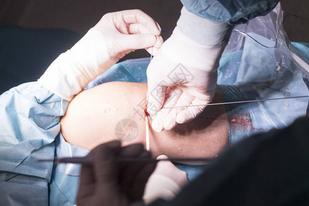 外科手术膝关节镜显微手术在医院手术室急诊室用于图片