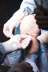 外科手术膝关节镜显微手术在医院手术室急诊室用于图片