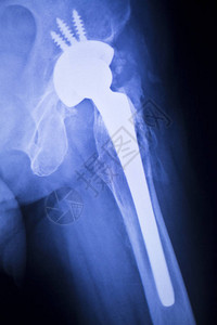 Hip合置X光显示球和插座关节的钛螺丝植入图片