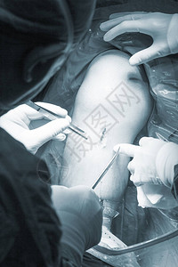 在医院手术的外科手术中进行膝盖动脉镜显微手术图片