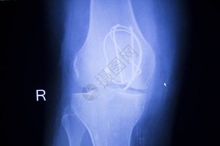 Knee联合植入线X光在整形外伤图片