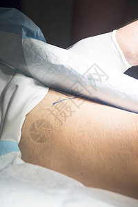 在手术室的病人腿部在医院急诊室外科手术图片