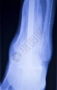 X光脚跟踝测试扫描结果显示图片