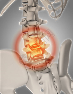 3D脊椎骨质的立体变形突图片