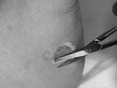 弯曲的小剪刀在男人脚后跟破裂的水泡处切割皮肤图片