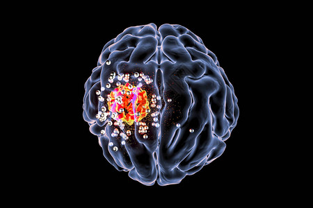 纳米粒子对脑肿瘤的破坏背景图片