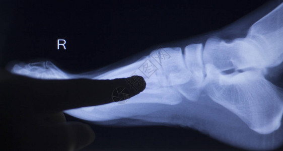 双脚指有关节炎和关节疼痛的病人足部联合X光图片