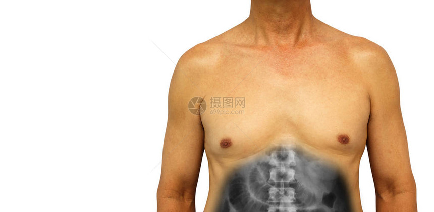 结肠癌和小肠梗阻人的腹部用X射线显示由于阻塞而扩张的小肠孤立的背景左图片