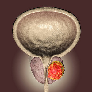 前列腺癌3D图解显示前列腺内有肿瘤背景图片