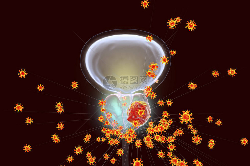 前列腺癌原学的概念图3D插图显示感染前列腺并发图片