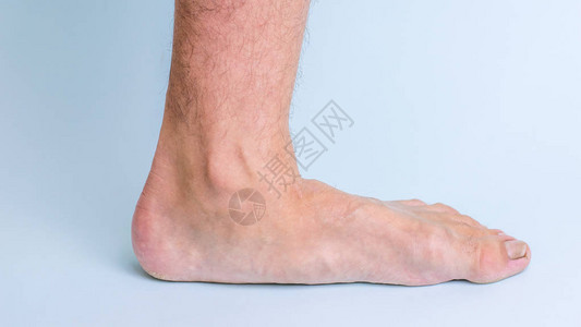 有关节疾病和扁平脚症状的人的左腿腿部和关节疾病高清图片