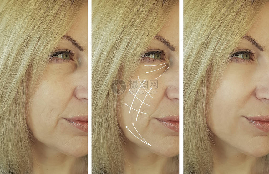 妇女面部皱纹矫正前后的程序箭头图片