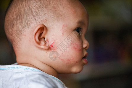 亚洲新生儿皮肤过敏引起的皮疹宝宝对面部疾病宝宝面部干燥皮肤瘙痒及病变图片