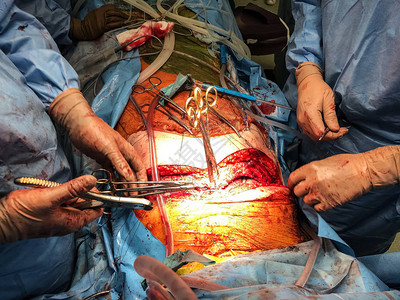 外科医生小组进行器官移植医学手术图片