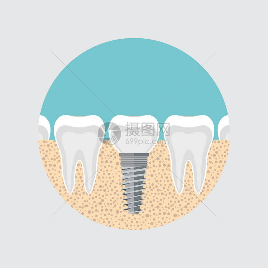 人类牙齿的植入物图片