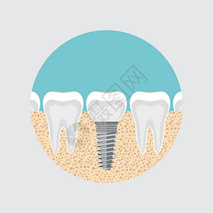 人类牙齿的植入物图片