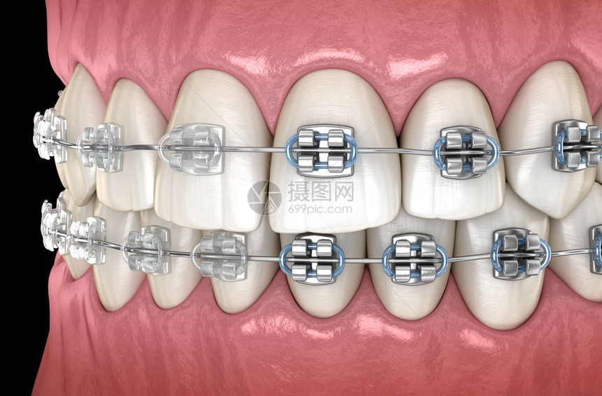 牙胶中带有金属和清晰牙套的牙齿医学上准确的图片