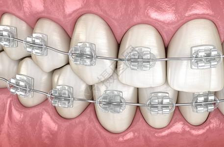 牙和清晰牙套医学上准确的图片